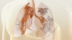 medizinische 3D Animation Patientenfilm Lungenfibrose Atemwege, Patientenaufklrungsfilm Pharma