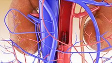 medizinische 3D-Animation pulsatile Herz-Kreislauf-Untersttzung - Kardiologie Herz Medizintechnik
